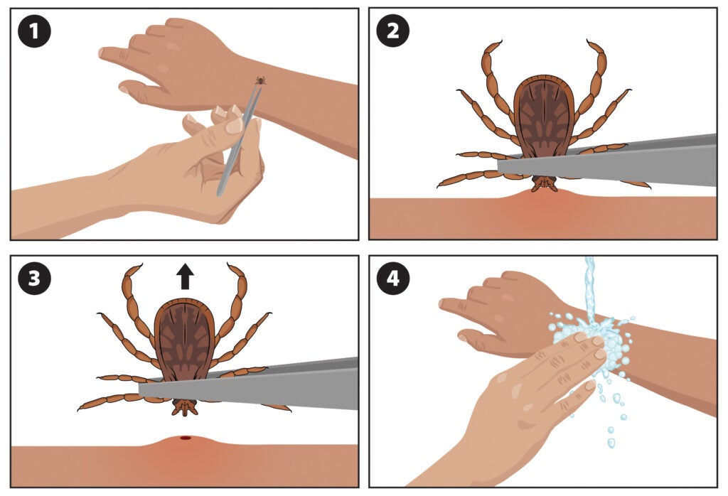 An illustrated guide to tick removal.