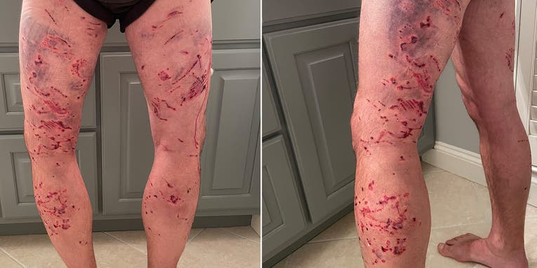 Georgia Hunter Suffers Hundreds of Bite Wounds During Brutal Dog Attack in the Woods