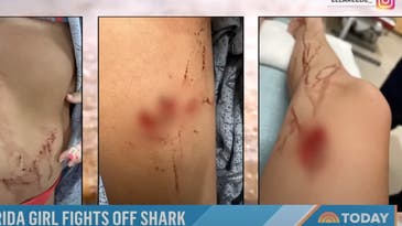 13-Year-Old Girl Fends Off Shark Attack on Florida Beach