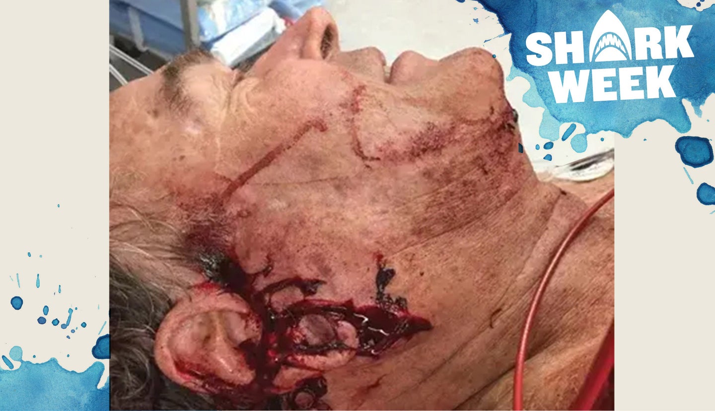 the bloody face of a fisherman who was attacked by a shark