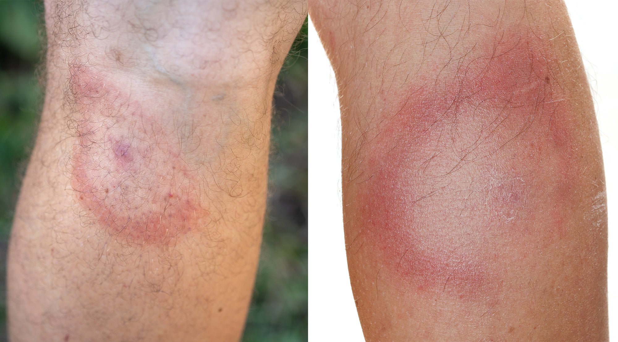 photos of bullseye rashes, a common tick bite symptom