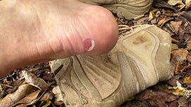 How to Treat Blisters