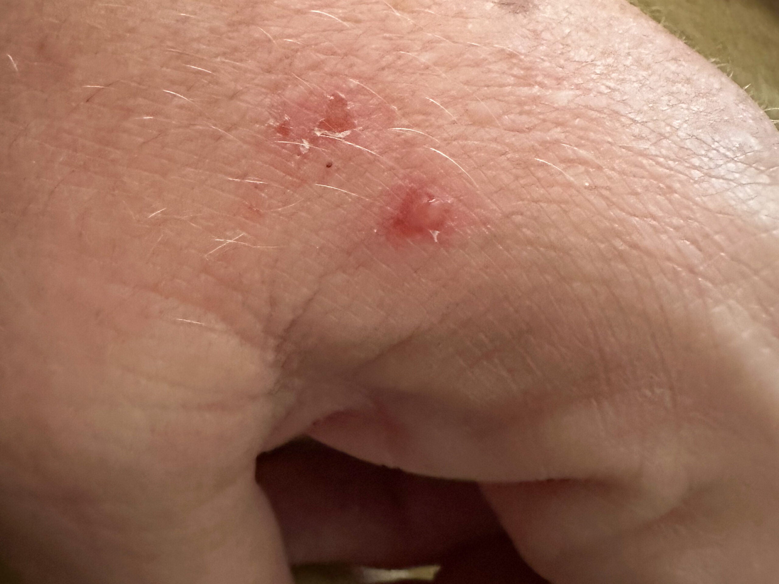 chigger bites on a person's hand
