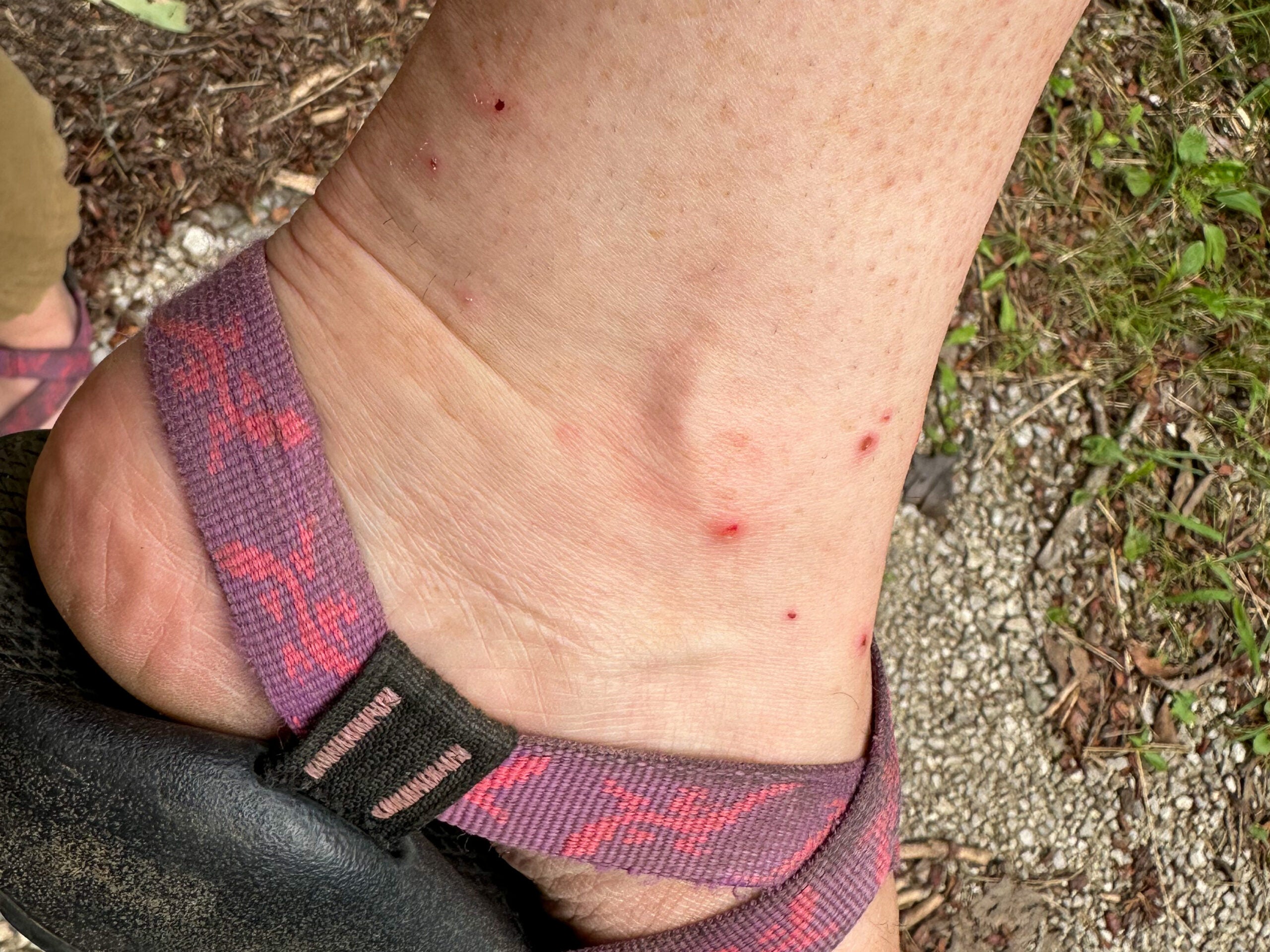 chigger bites around a person's ankle