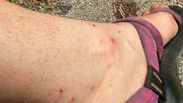 chigger bites on an ankle