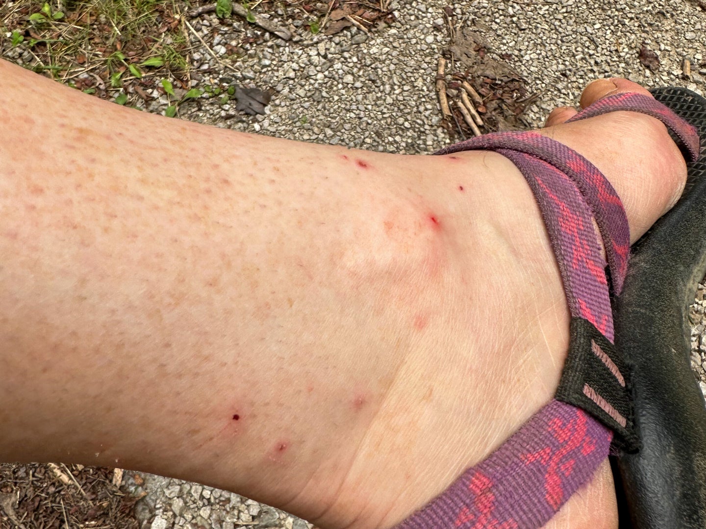 chigger bites on an ankle